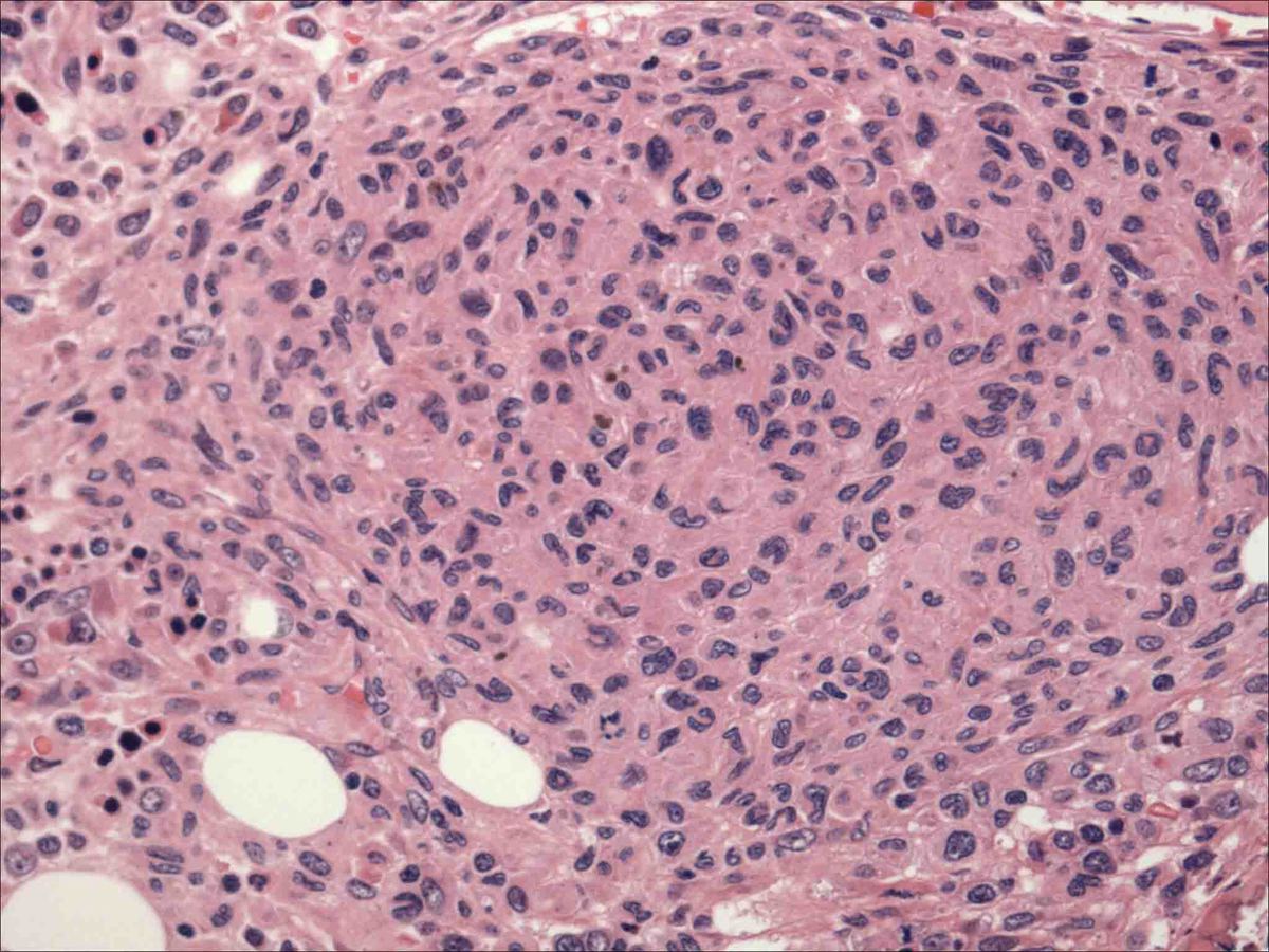 Bone marrow biopsy 8 months after T-ALL diagnosis.